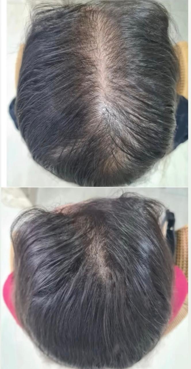 Antes e depois do tratamento capilar: risco central aberto antes e visivelmente mais preenchido depois