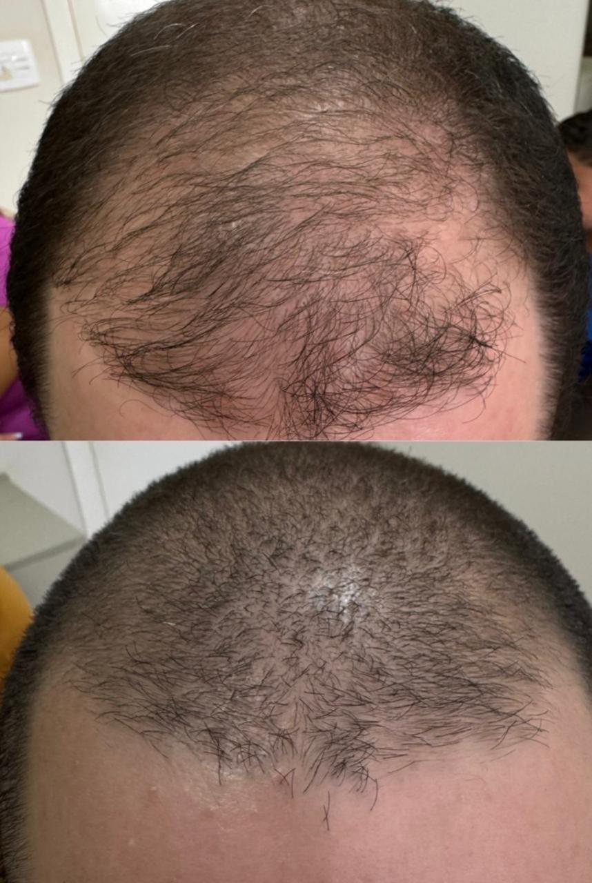Antes e depois do tratamento capilar: calvície masculina na região frontal